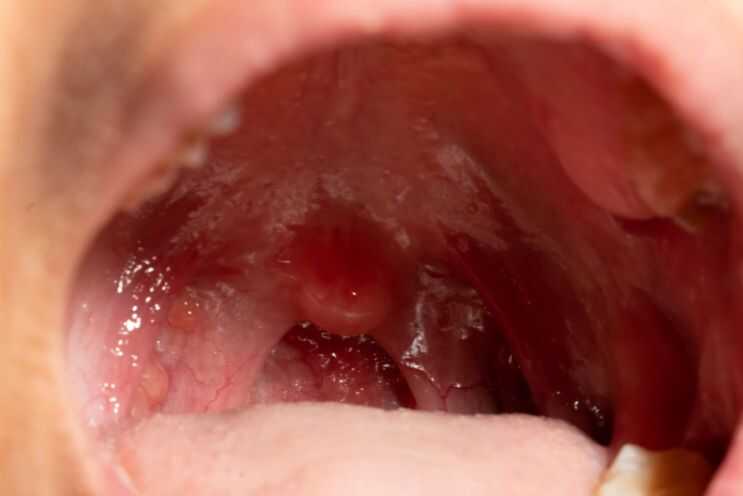 can cigarette smoke cause tonsillitis Tonsil Cancer: Signs, Symptoms and Treatment