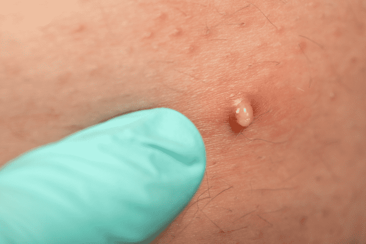How to treat and prevent vaginal boils