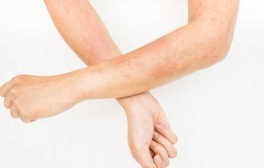 Fungal Infections Treatment Online