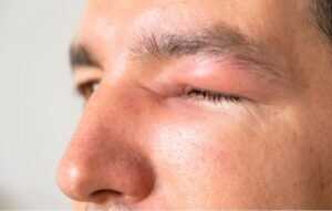why is my upper eyelid swollen