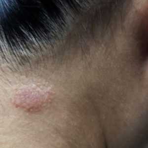 Ringworm treatment online