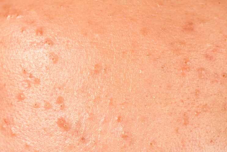 Pityrosporum Folliculitis: Causes, Symptoms, Treatments and Prevention
