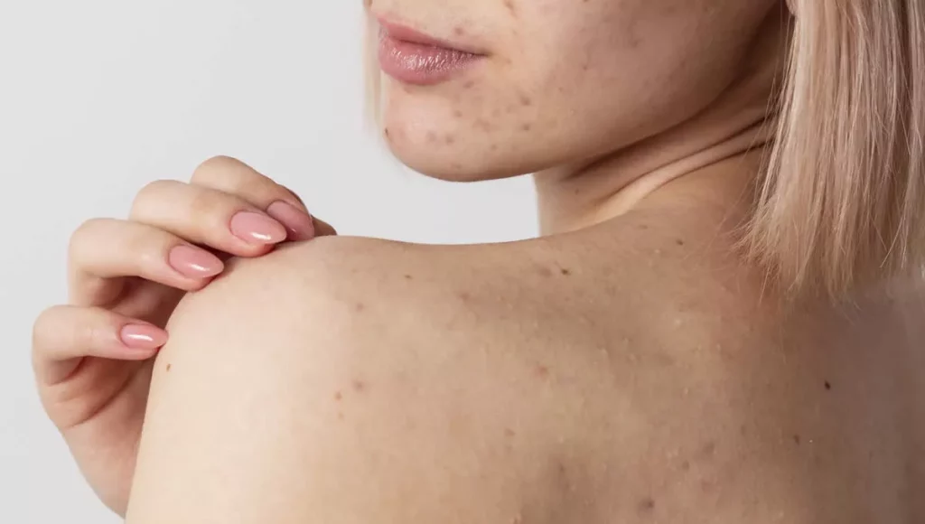 antibiotics for skin infections