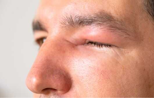 why is my upper eyelid swollen