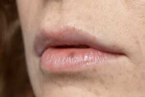 small bumps on lips no pain
