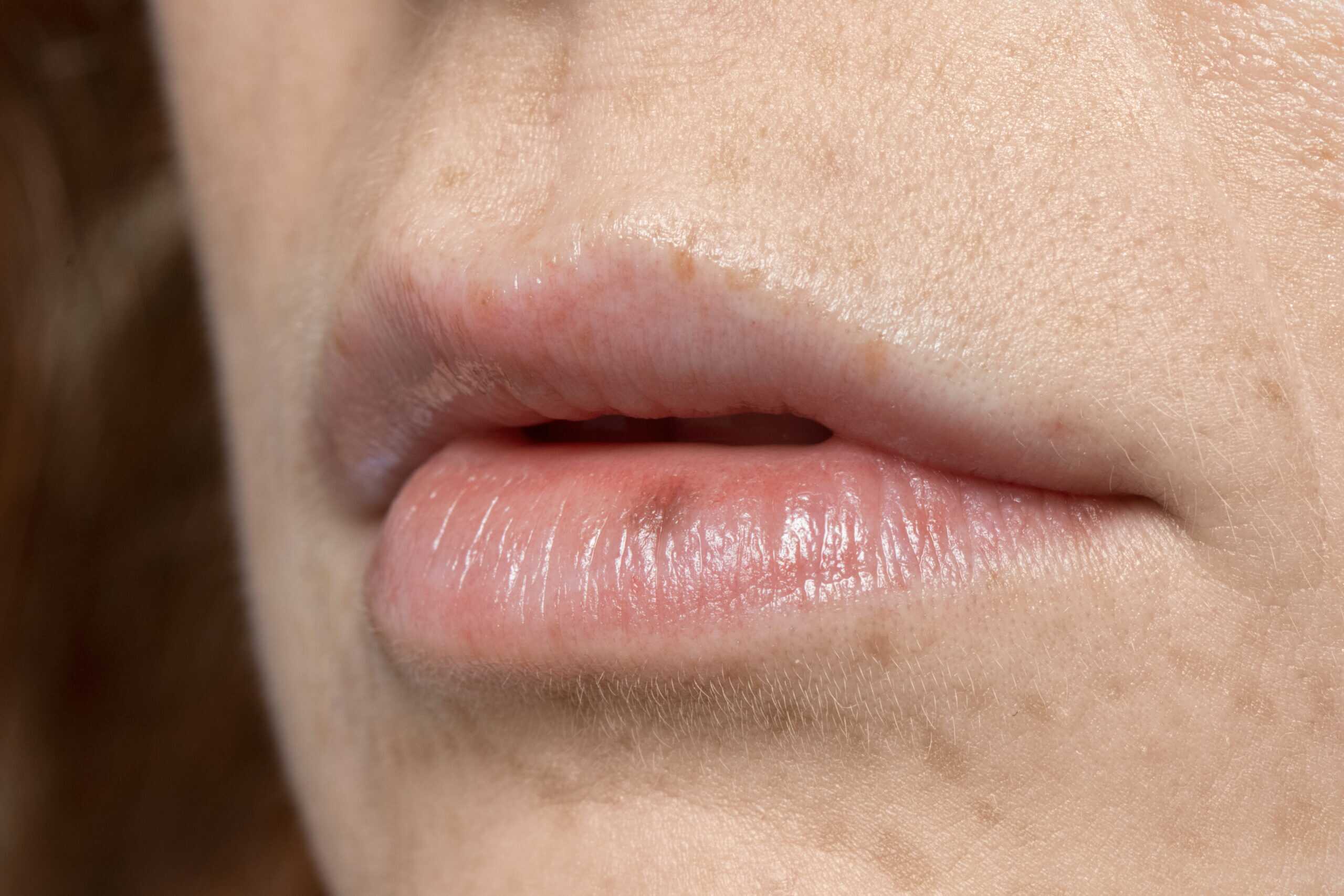 small bumps on lips no pain