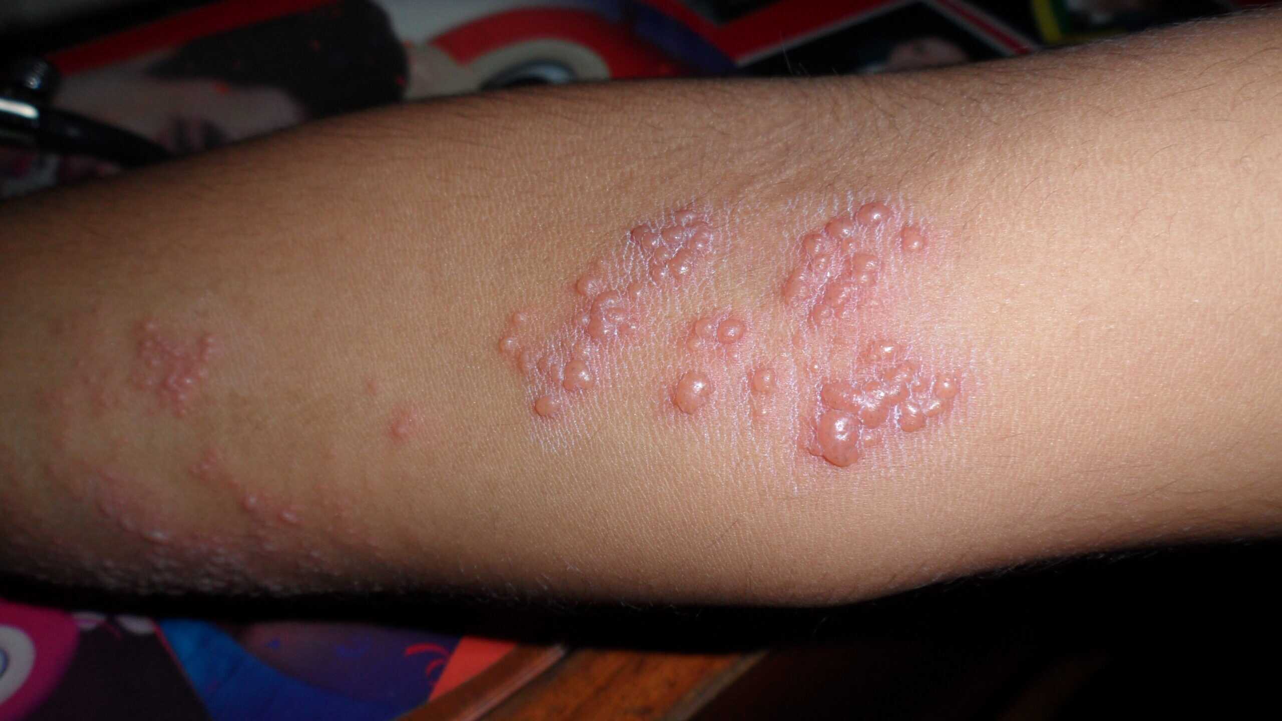 Herpes symptoms appear 2 to 12 days after exposure in most people, with an average of around 4 days.