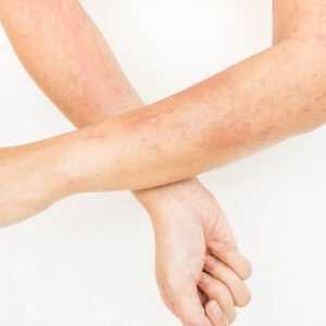 Fungal Infections Treatment Online