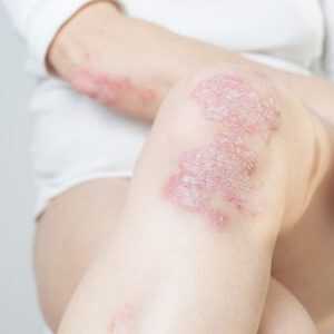Psoriasis Treatment Online